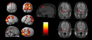 https://psychcentral.com/lib/what-is-functional-magnetic-resonance-imaging-fmri